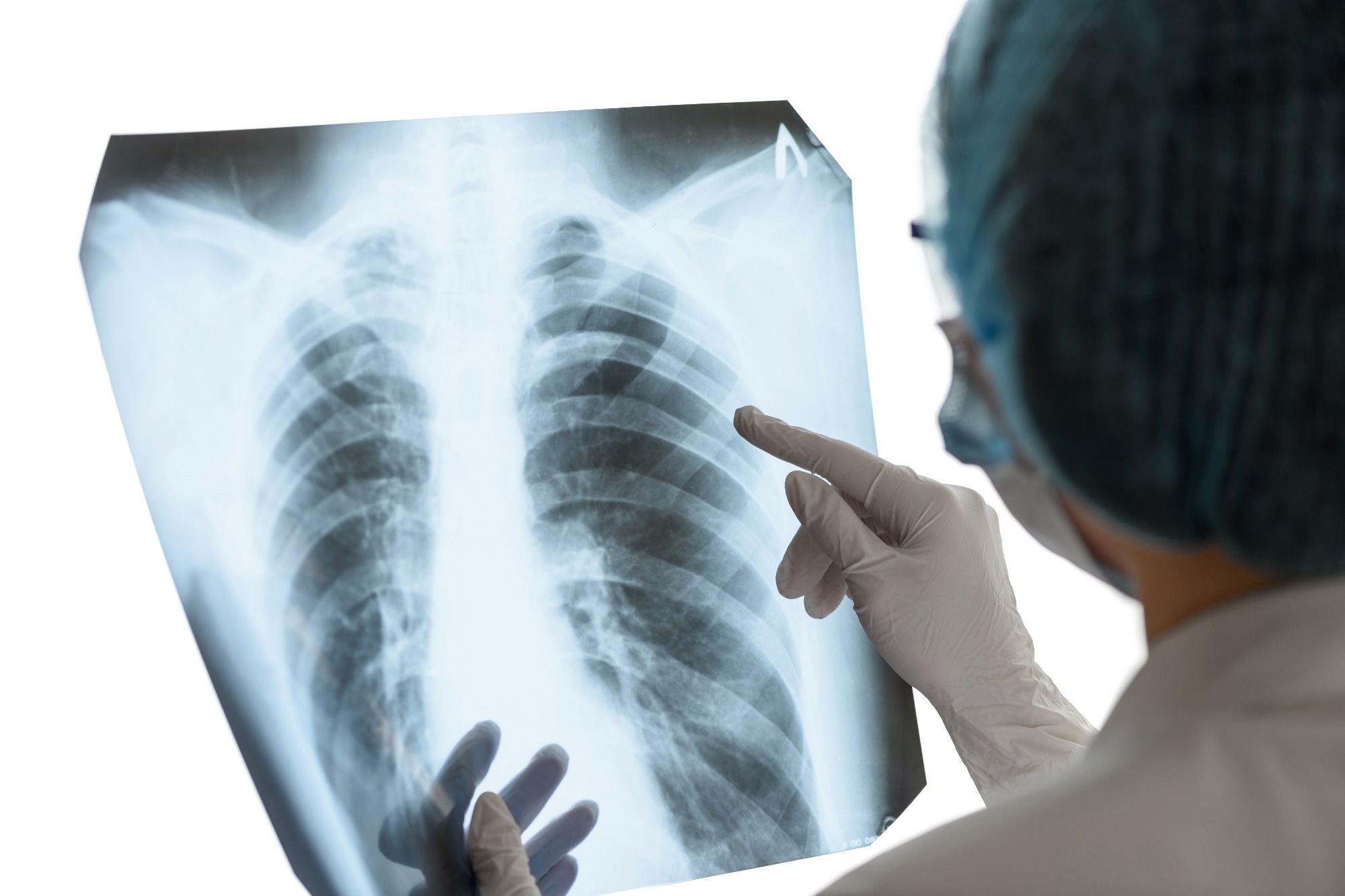 Study: AI and Smartphone Technology: Transforming Pulmonary Inflammation Diagnosis. Image credit: Andrey Zhernovoy/Shutterstock