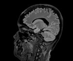 High-Accuracy Brain Tumor Detection through Deep Transfer Learning