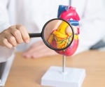 Sentiment Analysis Reveals Public Perceptions of Coronary Artery Calcium Testing