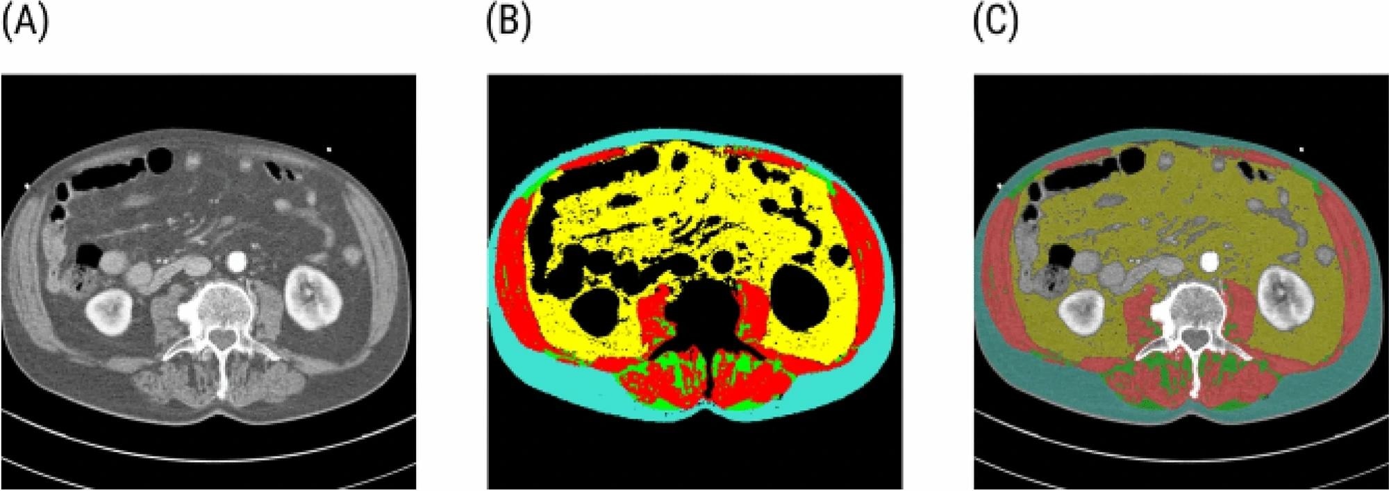 Segmentation of the CT L3 scan cross-section. (A) An example of a raw CT cross-section at the third lumbar vertebra level. (B) The segmentation map consists of the skeletal muscle tissue (red), intramuscular adipose tissue (green), visceral adipose tissue (yellow), and subcutaneous adipose tissue (turquoise). The black areas are excluded from the analysis. (C) An overlay of the segmentation map with the CT cross-section. https://www.nature.com/articles/s41598-024-59134-z